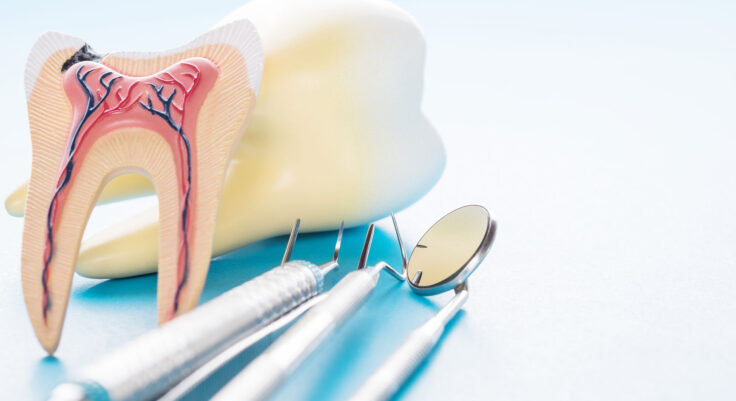 A endodontia ou tratamento de canal é a remoção da polpa do dente, um pequeno tecido semelhante a um fio que fica no interior do dente