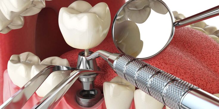 A implantodontia é o ramo da odontologia responsável por substituir dentes ausentes e suas funções. Para isso, utilizam-se os chamados implantes dentários, os quais assumem o espaço do dente ausente. Dessa forma, a mastigação e a estética bucal são restauradas.