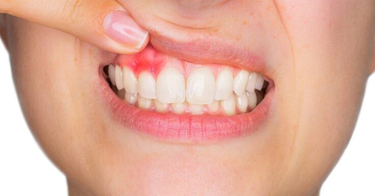 Periodontia é a especialidade odontológica que trata dos tecidos que dão sustentação para os dentes. Com objetivo de prevenir, diagnosticar e tratar problemas e doenças que atingem a gengiva, o ligamento periodontal e o osso alveolar.