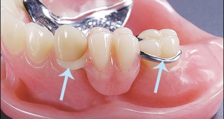 A prótese dentária é uma estrutura utilizada para substituir um ou mais dentes, assim como outras partes da boca, como gengiva ou ossos, promovendo a restauração do sorriso, além de melhorar a mastigação, a fala e a autoestima.